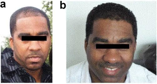 Before and after hair growth result