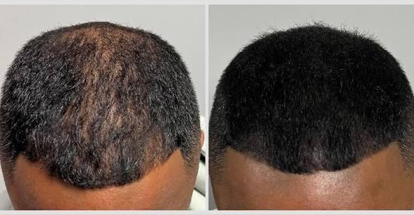 Thumbnail of before and after result 10