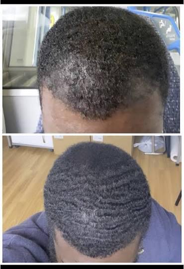 Thumbnail of before and after result 2