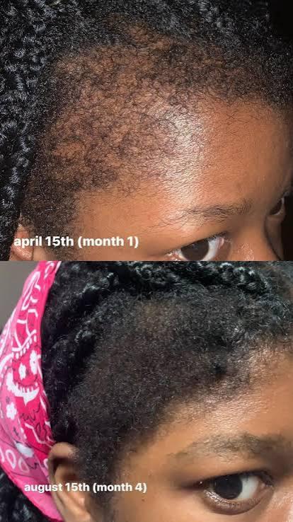 Thumbnail of before and after result 3