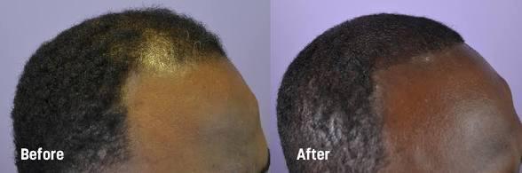Thumbnail of before and after result 4