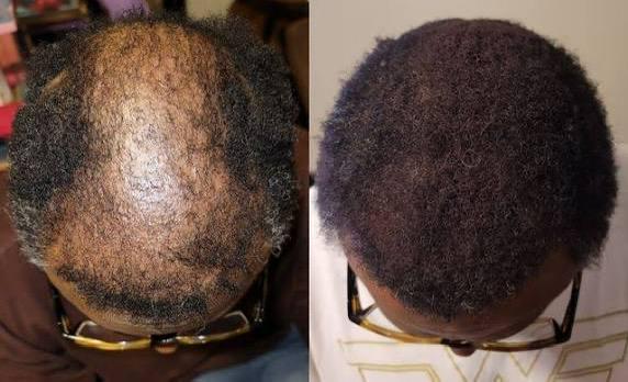 Thumbnail of before and after result 5