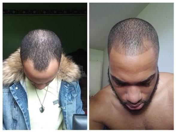 Thumbnail of before and after result 6