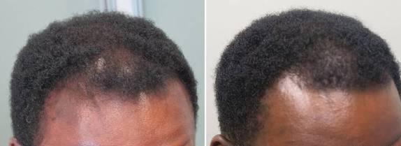 Thumbnail of before and after result 7